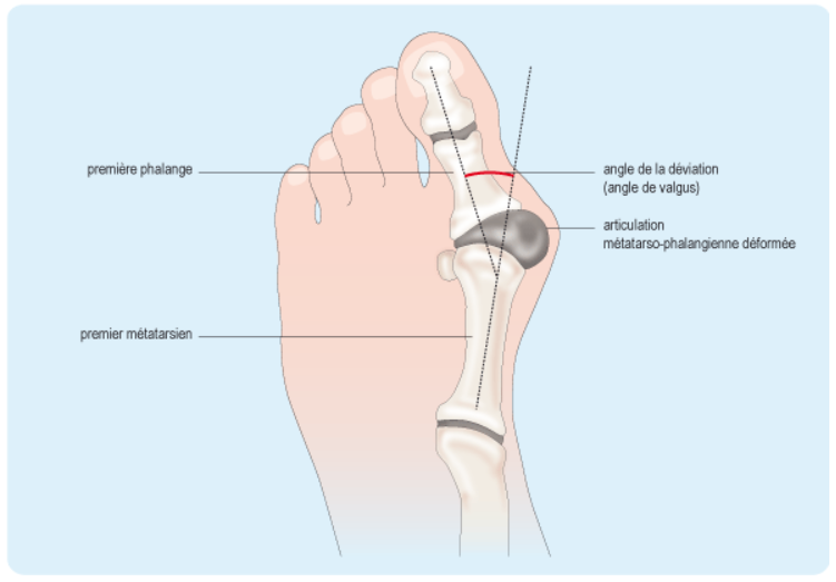 Déformation Hallux Valgus