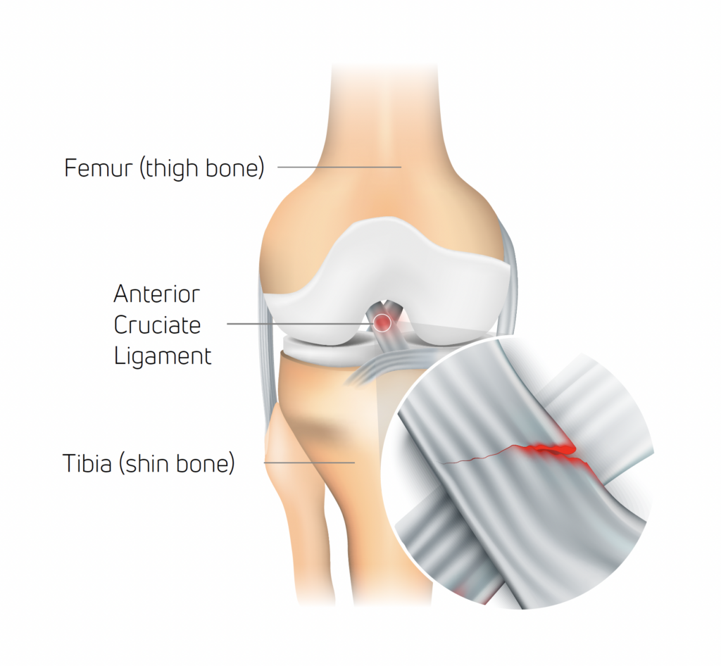 ACL injury