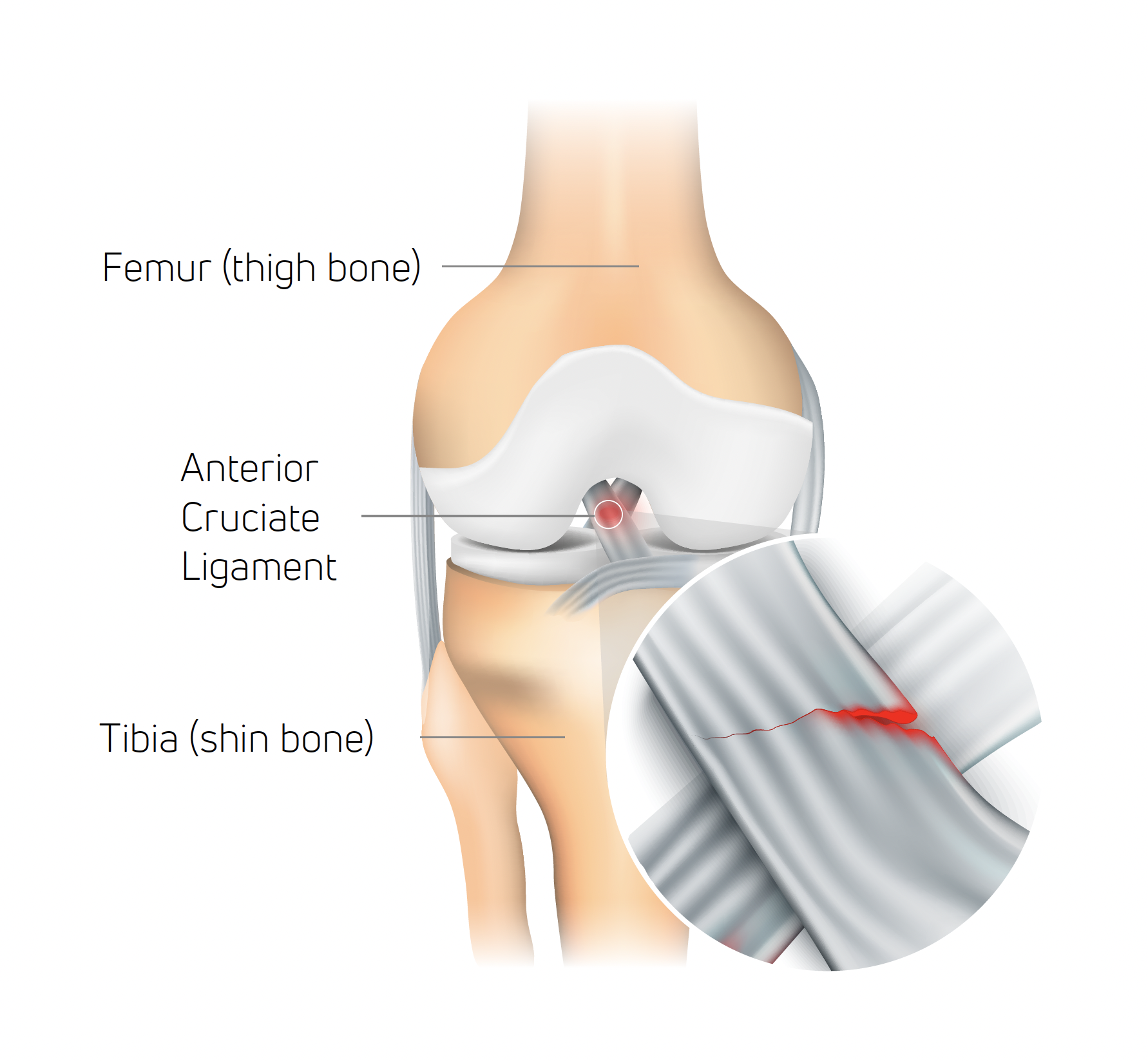 ACL Injury Bracing: Latest Research - Sports Medicine Review