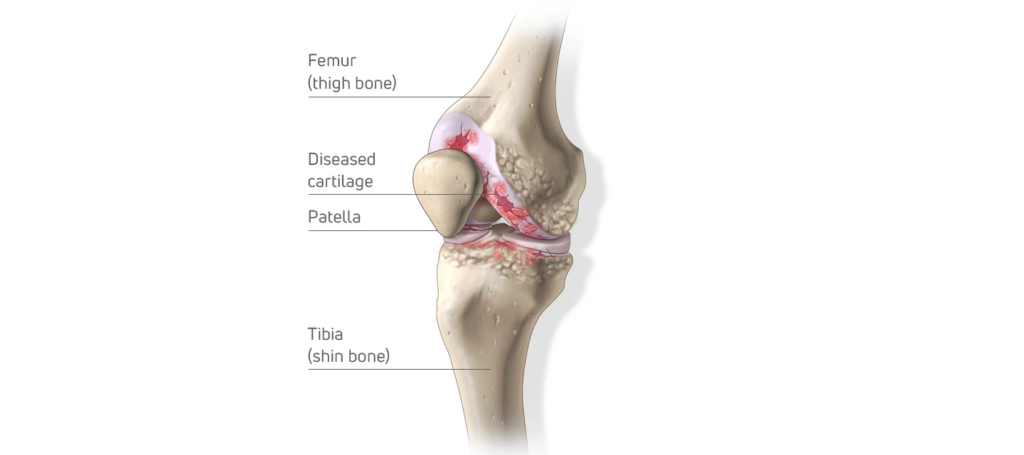 Knee osteoarthritis diagram