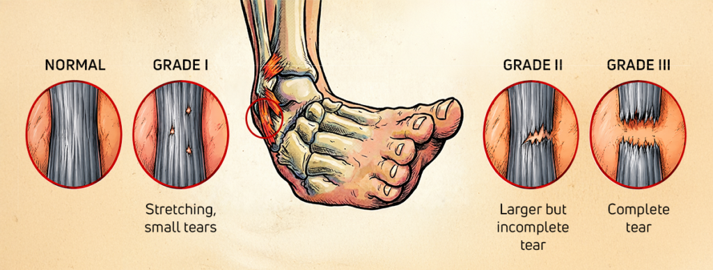 Grades of ankle sprain