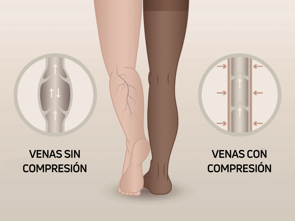 Venas con medias de compresión o sin