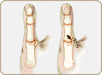 Instituto de la mano - Esguince del pulgar