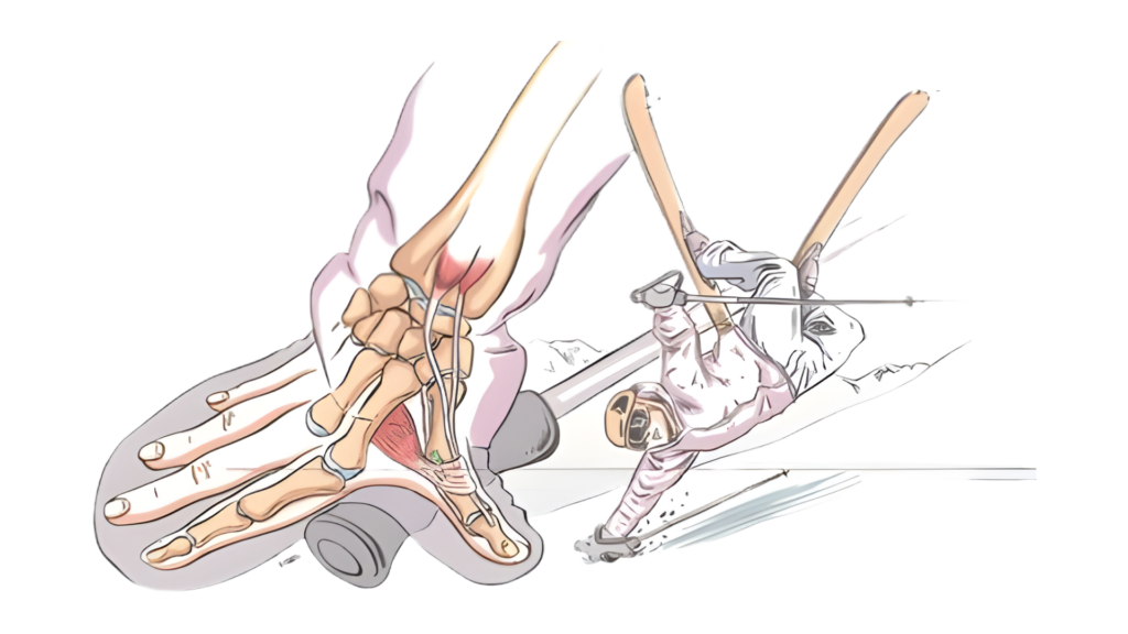 Visualización del estiramiento del LLI - Accidente de esquí