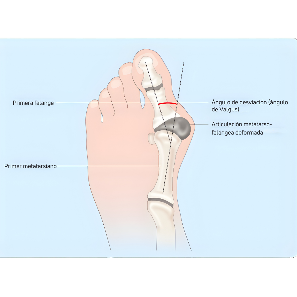 Hallux valgus o juanete